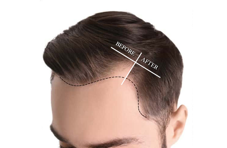 gs-hair-transplant-man-fue2