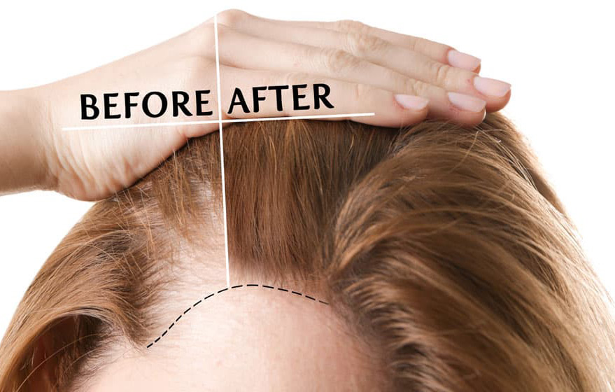 gs-hair-transplant-woman